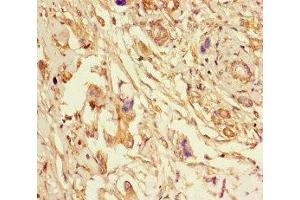 Immunohistochemistry of paraffin-embedded human pancreatic cancer using ABIN7151998 at dilution of 1:100 (ERLIN2 抗体  (AA 25-206))