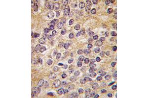 Formalin-fixed and paraffin-embedded human prostata carcinoma tissue reacted with PLAU antibody (C-term ), which was peroxidase-conjugated to the secondary antibody, followed by DAB staining. (PLAU 抗体  (C-Term))