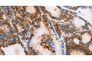 Immunohistochemistry of paraffin-embedded Human thyroid cancer tissue using MUC6 Polyclonal Antibody at dilution 1:40 (MUC6 抗体)
