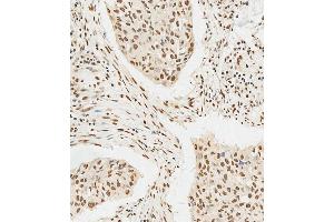 C staining HS in human lung adenocarcinoma tissue sections by Immunohistochemistry (IHC-P - paraformaldehyde-fixed, paraffin-embedded sections). (HSPA7 抗体  (AA 169-196))
