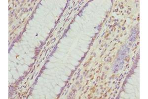 Immunohistochemistry of paraffin-embedded human colon cancer using ABIN7156409 at dilution of 1:100 (Integrator Complex Subunit 14 (INTS14) (AA 231-518) 抗体)