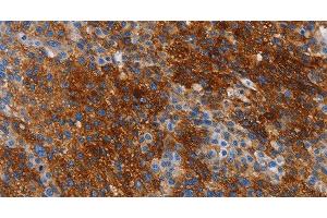 Immunohistochemistry of paraffin-embedded Human liver cancer tissue using CA9 Polyclonal Antibody at dilution 1:50 (CA9 抗体)