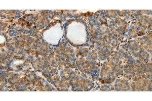 Immunohistochemistry of paraffin-embedded Human thyroid cancer using SULT1E1 Polyclonal Antibody at dilution of 1:30 (SULT1E1 抗体)