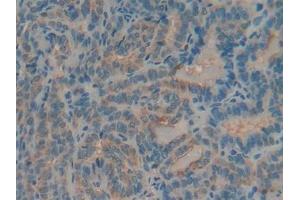 Detection of MUC5AC in Human Thyroid cancer Tissue using Polyclonal Antibody to Mucin 5 Subtype AC (MUC5AC) (MUC5AC 抗体)