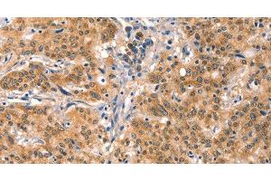 Immunohistochemistry of paraffin-embedded Human gastric cancer using EIF4G1 Polyclonal Antibody at dilution of 1:30 (EIF4G1 抗体)