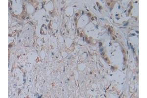 DAB staining on IHC-P;;Samples: Human Pancreatic cancer Tissue (CCL2 抗体  (AA 24-99))