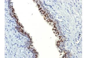 Formalin-fixed, paraffin-embedded human Prostate Carcinoma stained with FOXA1 Monoclonal Antibody (FOXA1/1514). (FOXA1 抗体  (AA 372-472))