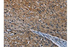The image on the left is immunohistochemistry of paraffin-embedded Human esophagus cancer tissue using ABIN7190993(HOXC8 Antibody) at dilution 1/20, on the right is treated with synthetic peptide. (HOXC8 抗体)