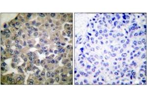 Immunohistochemistry analysis of paraffin-embedded human breast carcinoma tissue, using PLCG1 (Ab-771) Antibody. (Phospholipase C gamma 1 抗体  (AA 736-785))