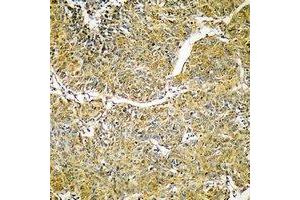 Immunohistochemical analysis of SVOP staining in human liver cancer formalin fixed paraffin embedded tissue section. (SVOP 抗体)