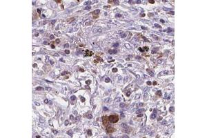 BNIPL Antibody on lung cancer by IHC. (BNIPL 抗体)