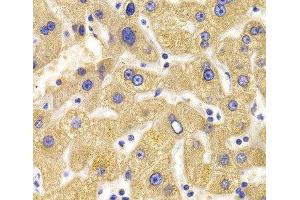 Immunohistochemistry of paraffin-embedded Human liver damage using KIF1B Polyclonal Antibody at dilution of 1:100 (40x lens). (KIF1B 抗体)