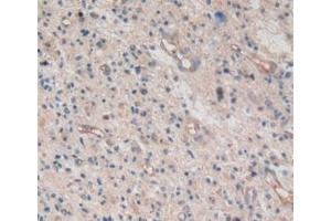 Detection of AREG in Human Glioma Tissue using Monoclonal Antibody to Amphiregulin (AREG) (Amphiregulin 抗体  (AA 20-100))