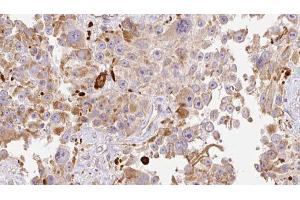 ABIN6274013 at 1/100 staining Human Melanoma tissue by IHC-P. (HAPLN1 抗体  (N-Term))