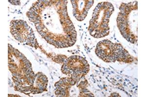 The image on the left is immunohistochemistry of paraffin-embedded Human colon cancer tissue using ABIN7190920(HCRTR1 Antibody) at dilution 1/70, on the right is treated with synthetic peptide.