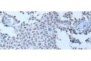 Immunohistochemistry of paraffin-embedded Human ovarian cancer tissue using ZNF703 Polyclonal Antibody at dilution of 1:55(x200) (ZNF703 抗体)