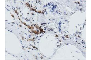 Immunohistochemical staining of paraffin-embedded Carcinoma of Human lung tissue using anti-ARHGAP25 mouse monoclonal antibody. (ARHGAP25 抗体)