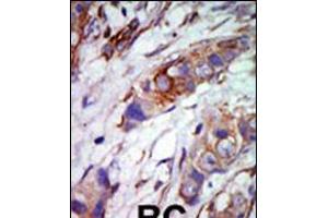 Formalin-fixed and paraffin-embedded human cancer tissue reacted with the primary antibody, which was peroxidase-conjugated to the secondary antibody, followed by AEC staining. (MAPK7 抗体  (C-Term))