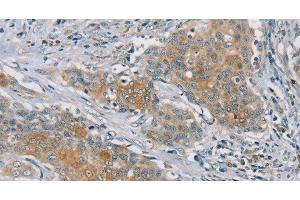 Immunohistochemistry of paraffin-embedded Human ovarian cancer tissue using RASA2 Polyclonal Antibody at dilution 1:45 (RASA2 抗体)