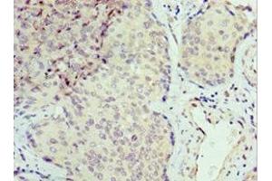 Immunohistochemistry of paraffin-embedded human cervical cancer using ABIN7168869 at dilution of 1:100 (Septin 6 抗体  (AA 350-434))
