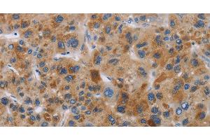 Immunohistochemistry of paraffin-embedded Human liver cancer tissue using IAPP Polyclonal Antibody at dilution 1:40 (Amylin/DAP 抗体)