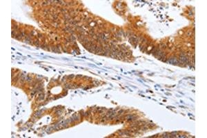 The image on the left is immunohistochemistry of paraffin-embedded Human colon cancer tissue using ABIN7131154(SPATA13 Antibody) at dilution 1/20, on the right is treated with fusion protein. (SPATA13 抗体)