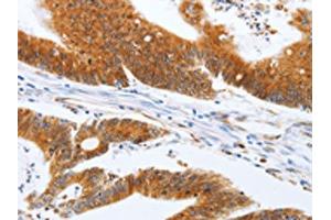 The image on the left is immunohistochemistry of paraffin-embedded Human colon cancer tissue using ABIN7131154(SPATA13 Antibody) at dilution 1/20, on the right is treated with fusion protein.