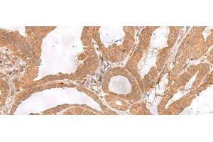 Immunohistochemistry of paraffin-embedded Human thyroid cancer tissue using ETV3 Polyclonal Antibody at dilution of 1:25(x200) (ETV3 抗体)
