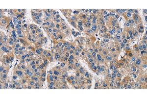 Immunohistochemistry of paraffin-embedded Human liver cancer tissue using KLK1 Polyclonal Antibody at dilution 1:40 (Kallikrein 1 抗体)