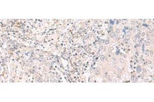 Immunohistochemistry of paraffin-embedded Human cervical cancer tissue using IL12B Polyclonal Antibody at dilution of 1:35(x200) (IL12B 抗体)