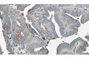 ABIN6277082 at 1/100 staining Human cervical cancer tissue by IHC-P. (TRKA 抗体  (C-Term))