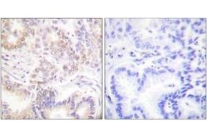 Immunohistochemistry analysis of paraffin-embedded human lung carcinoma tissue, using SENP5 Antibody. (SENP5 抗体  (AA 651-700))