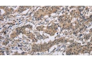 Immunohistochemistry of paraffin-embedded Human gastric cancer tissue using DSG2 Polyclonal Antibody at dilution 1:50 (Desmoglein 2 抗体)