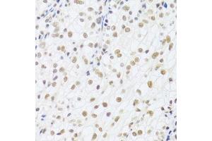 Immunohistochemistry of paraffin-embedded human kidney cancer using DDB1 Antibody. (DDB1 抗体)