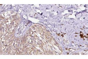 ABIN6279754 at 1/100 staining Human Melanoma tissue by IHC-P. (Reelin 抗体  (N-Term))