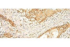 Immunohistochemistry of paraffin-embedded Human esophagus cancer tissue using EEF1AKMT2 Polyclonal Antibody at dilution of 1:50(x200) (METTL10 抗体)