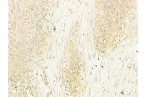 ABIN6262728 and ABIN6278924 at 1/100 staining human cervical carcinoma by IHC-P.