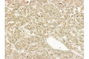 ABIN6265321 and ABIN6269248 at 1/100 staining human renal cell carcinoma by IHC-P.