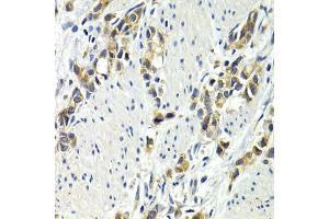 Immunohistochemistry of paraffin-embedded human gastric cancer using WNT3A antibody. (WNT3A 抗体)