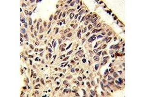 IHC analysis of FFPE human lung carcinoma stained with H4 antibody (HIST1H4A 抗体  (meLys20))