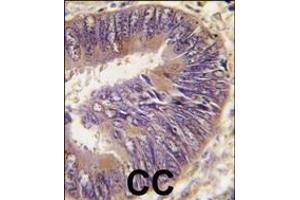 Formalin-fixed and paraffin-embedded human colon carcinoma tissue reacted with ST13 antibody (N-term), which was peroxidase-conjugated to the secondary antibody, followed by DAB staining. (HSC70 Interacting Protein HIP 抗体  (AA 50-80))