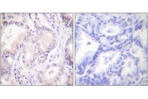 Immunohistochemistry analysis of paraffin-embedded human lung carcinoma, using CDC6 (Phospho-Ser54) Antibody.
