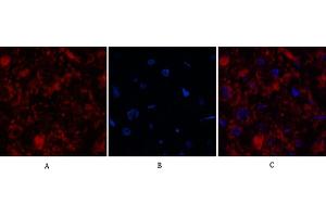 Immunofluorescence analysis of human kidney-cancer tissue. (Caspase 3 p12 (AA 130-210), (Cleaved-Asp175) 抗体)
