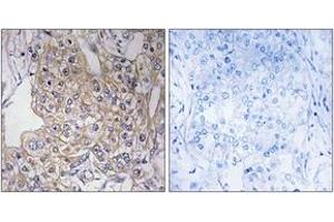 Immunohistochemistry analysis of paraffin-embedded human breast carcinoma tissue, using TNXB Antibody. (TNXB 抗体  (AA 1761-1810))