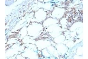 Formalin-fixed, paraffin-embedded human Mesothelioma stained with Calretinin Mouse Monoclonal Antibody (CALB2/2603). (Calretinin 抗体  (AA 23-242))