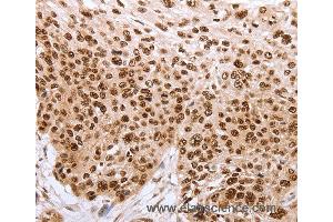 Immunohistochemistry of Human esophagus cancer using PARP1 Polyclonal Antibody at dilution of 1:40 (PARP1 抗体)