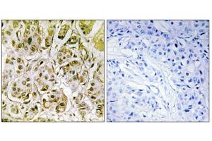 Immunohistochemistry analysis of paraffin-embedded human breast carcinoma tissue, using Smad1 (Phospho-Ser187) antibody. (SMAD1 抗体  (pSer187))
