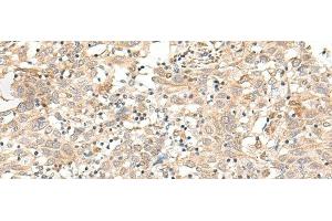 Immunohistochemistry of paraffin-embedded Human cervical cancer tissue using FUT3 Polyclonal Antibody at dilution of 1:35(x200) (FUT3 抗体)