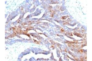 IHC staining of human ovarian carcinoma with TAG-72 antibody (TAG-72 抗体)