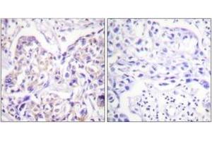 Immunohistochemistry analysis of paraffin-embedded human breast carcinoma tissue, using IRS-1 (Ab-323) Antibody. (IRS1 抗体  (AA 289-338))